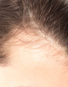 How To Reduce Hair Fall
