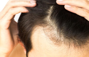 Can hair transplant from another person?