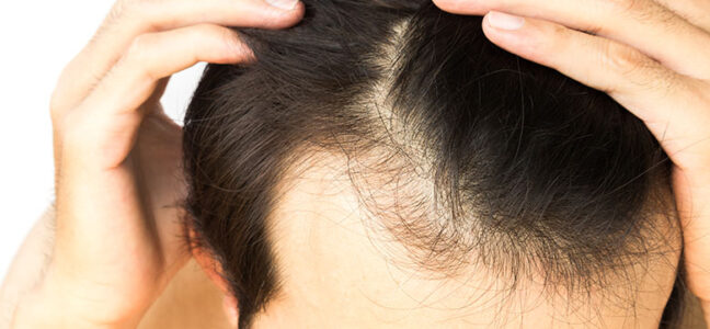 Can hair transplant from another person?